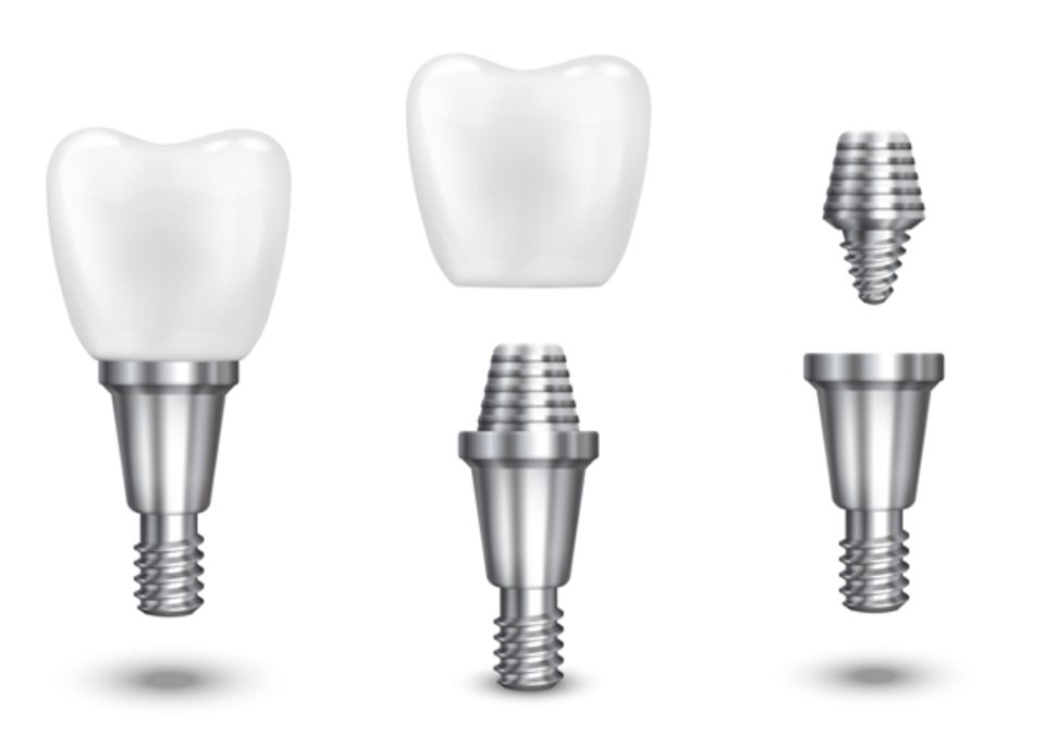 Implants dentals a Manresa